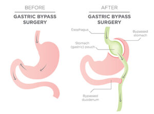 Fragen zur Operation zur Gewichtsreduktion: Nach der Magenverkleinerung in Antalya kehren viele Patienten innerhalb von ein bis zwei Wochen..